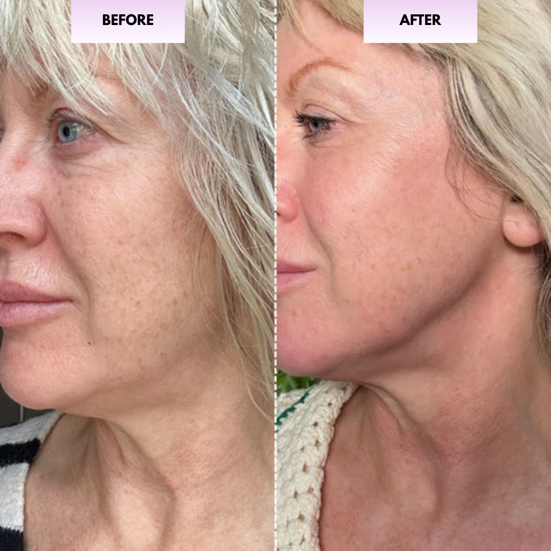 Before and after cheek and neck