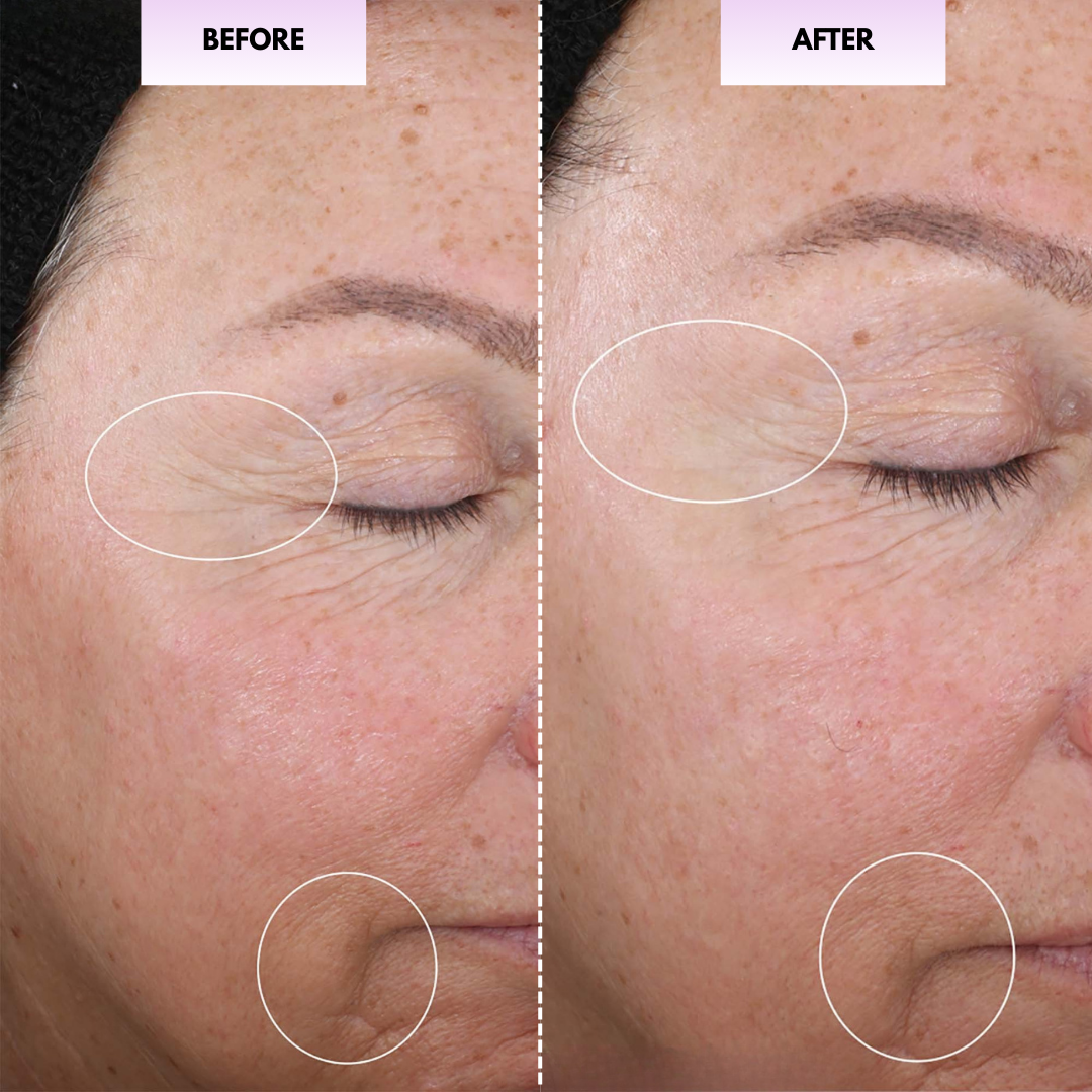 Before and after eye area